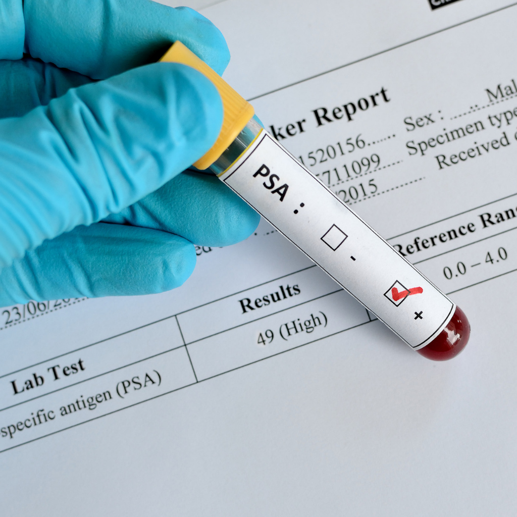 Gloved hand holding PSA test blood sample tube for PERFIL PROSTÁTICO II prostate health screening