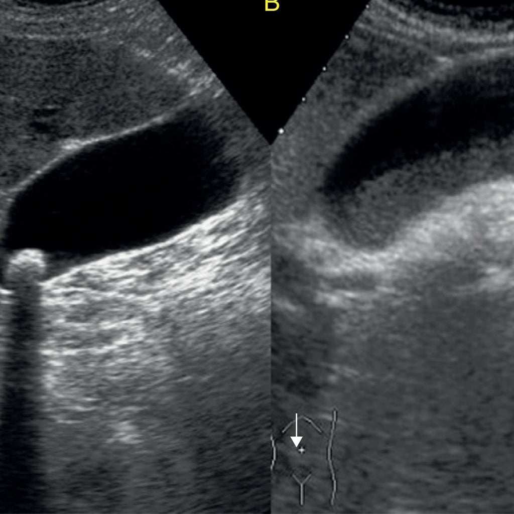 Ultrasound image showing liver, gallbladder, and bile ducts for ULTRASONIDO HÍGADO diagnosis and evaluation