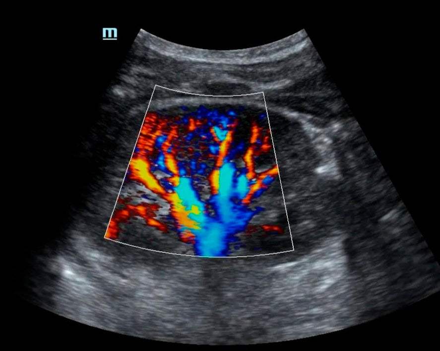 Ultrasonido Doppler renal showing blood flow in kidney arteries with color mapping