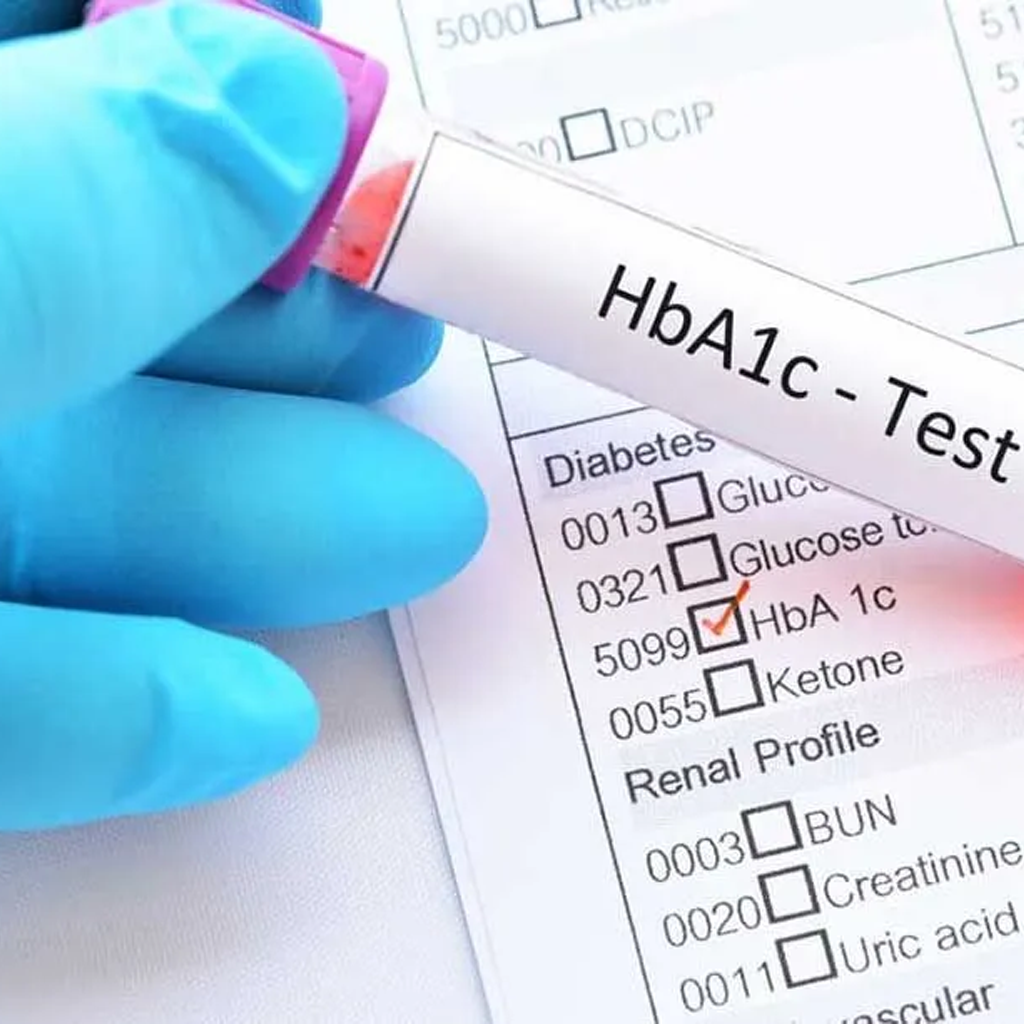 Gloved hand holding blood sample tube marked HbA1c test for hemoglobina glucosilada diabetes screening