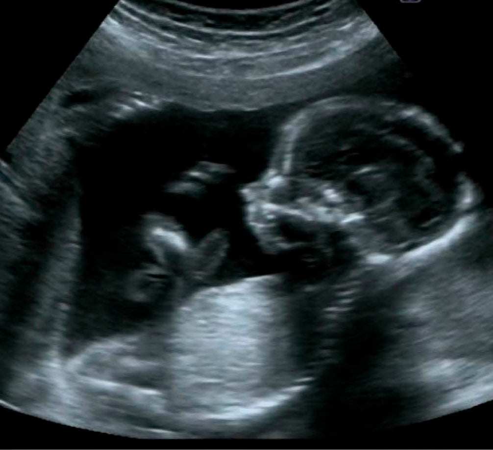 Ultrasound image of fetus showing prenatal development for Ultrasonido Obstétrico 1-2-3 Trimestre Omedic