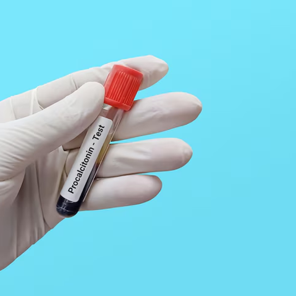 Hand holding a blood sample tube labeled Procalcitonin Test against a blue background for bacterial or viral infection diagnosis