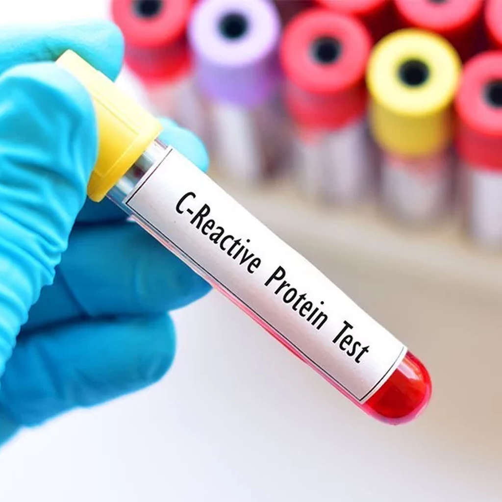 Blood sample for C-reactive protein test detecting inflammation in the body