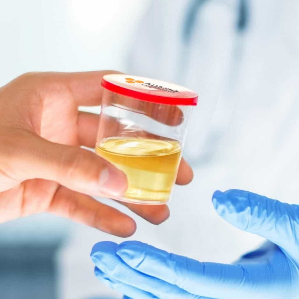 Hand holding urine sample container for 24-hour protein in urine test labeled proteínas en orina