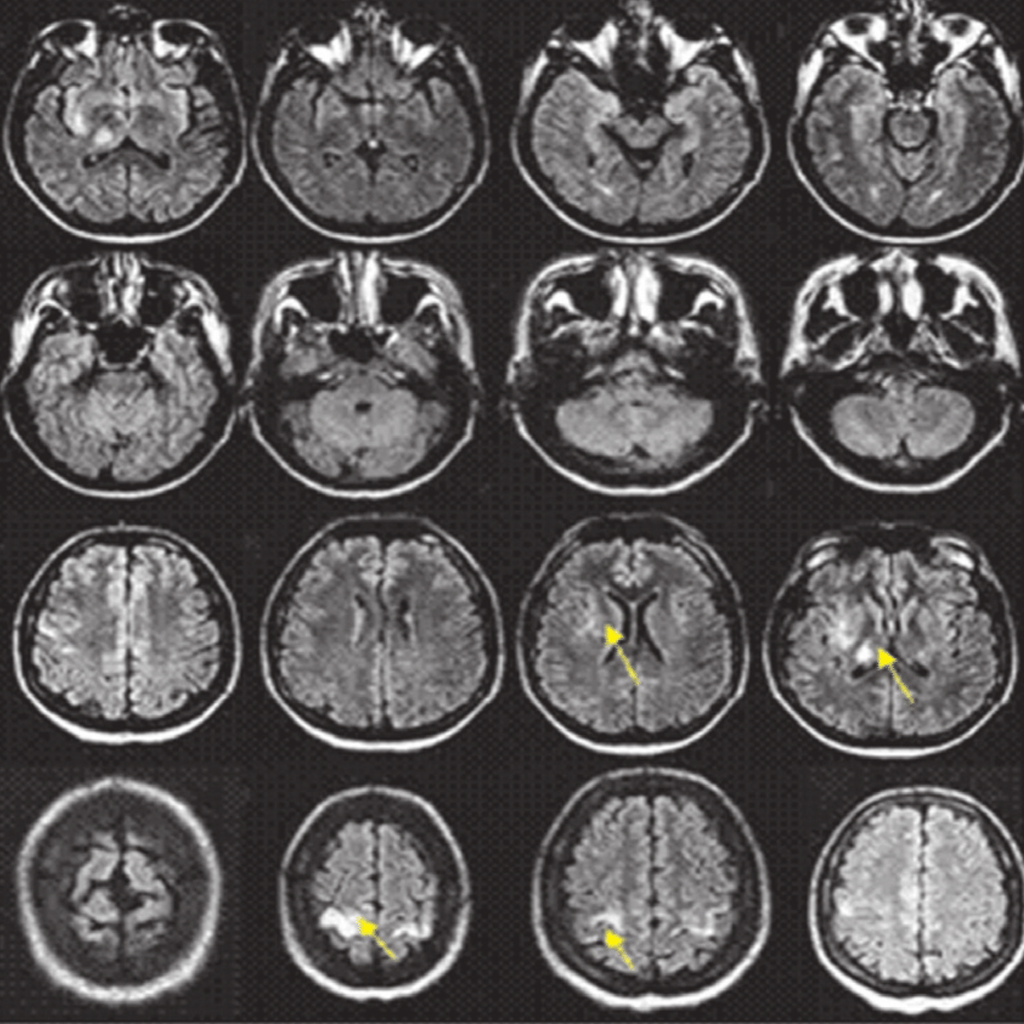 MRI brain scan images showing multiple cross-sectional views highlighting areas of interest with arrows, representing resonancia magnetica simple.
