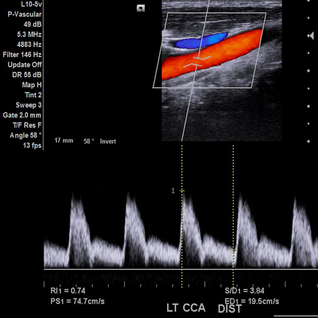 Ultrasonido Doppler arterial y venoso de dos miembros mostrando flujo sanguíneo en arterias y venas con datos de velocidad y resistencia.