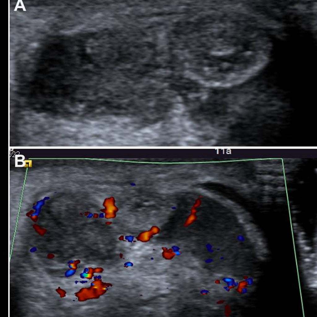 Ultrasound Doppler testicular scan showing grayscale and color flow imaging to assess blood circulation and detect abnormalities in testicles.