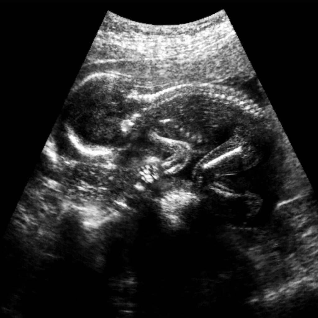 Ultrasonido estructural showing detailed anatomical structure of a baby including spine, limbs, and fingers with placental position and organs view.