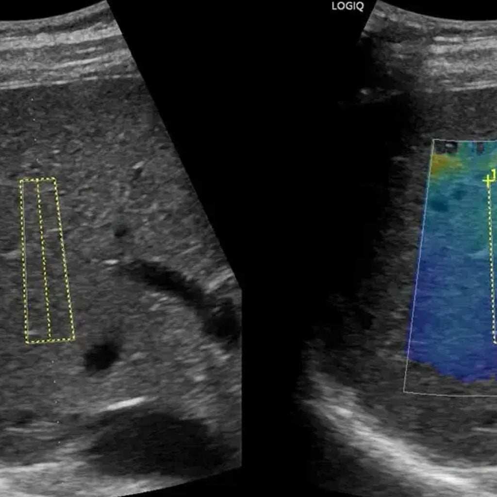 Ultrasound image of abdominal wall showing inguinal hernia evaluation with color Doppler and measurement markers