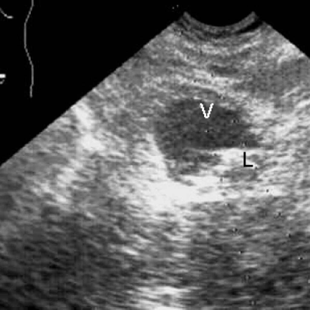 Suprapubic prostate ultrasound image showing prostate evaluation for enlargement and urinary symptoms.