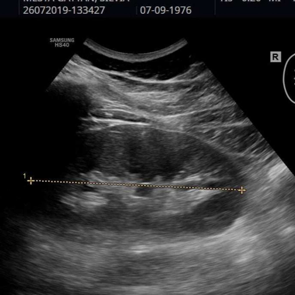 Ultrasonido renal diagnóstico imagen en blanco y negro del riñón evaluando salud y función renal