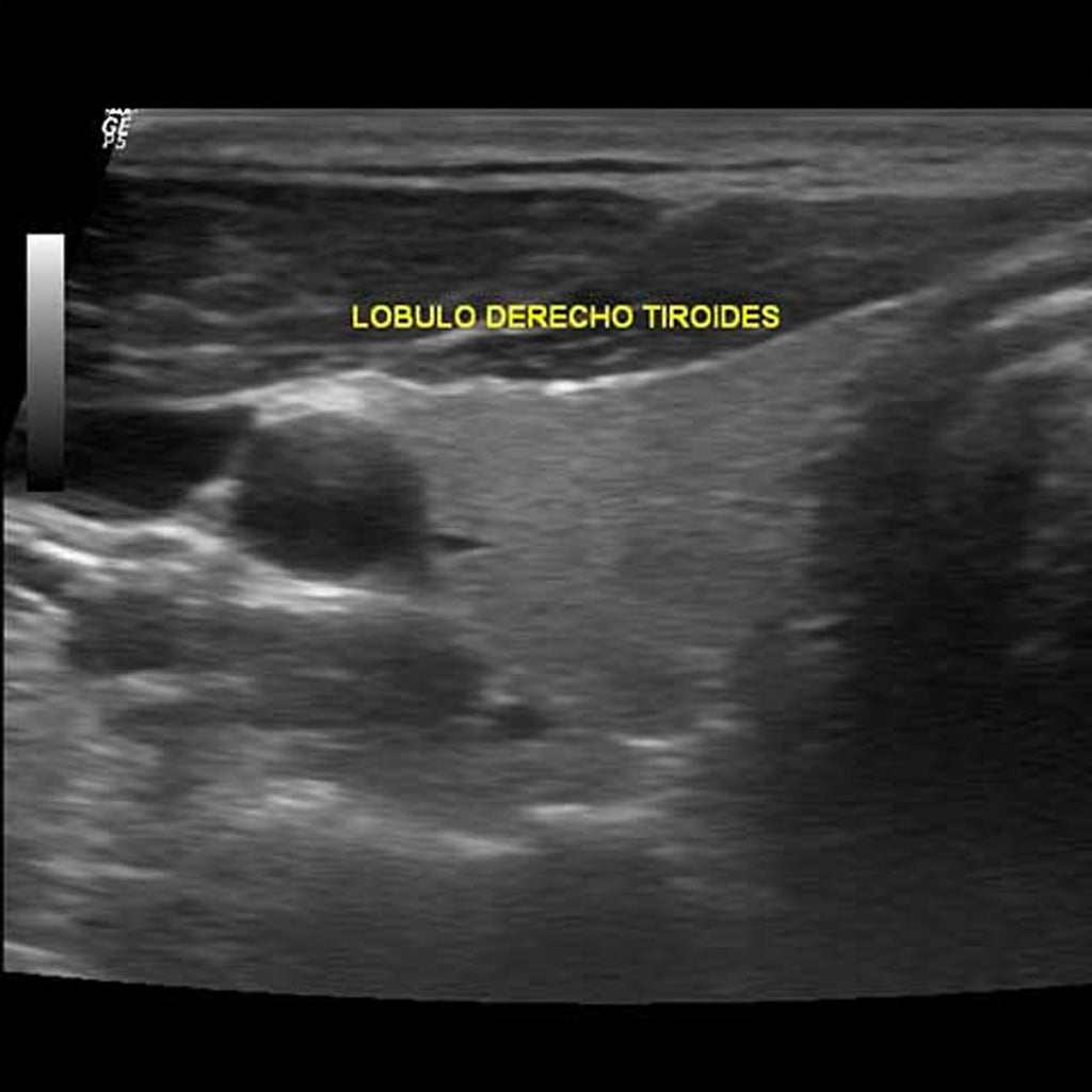 Thyroid ultrasound image showing right thyroid lobe with high-frequency sound wave imaging for non-invasive thyroid evaluation.