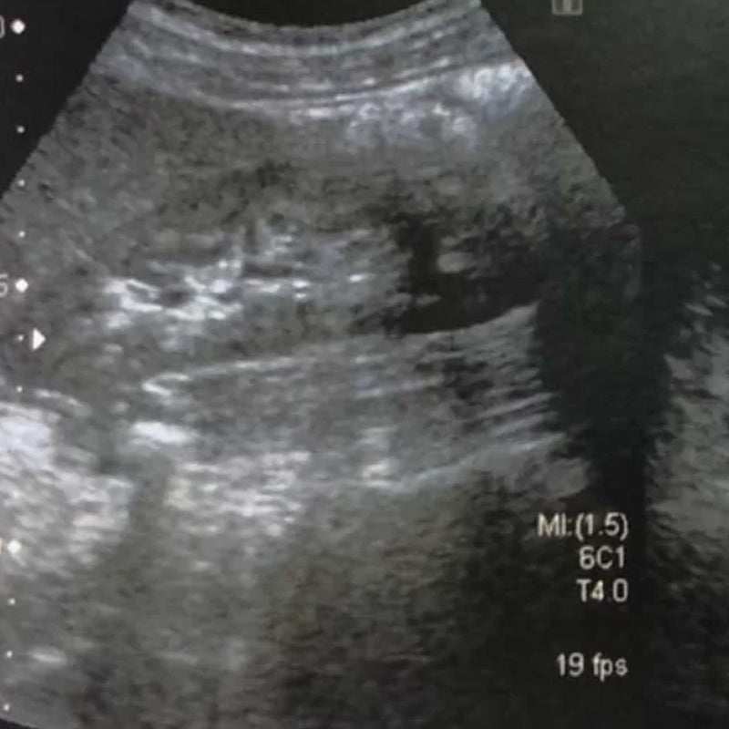 En resumen, el ultrasonido abdomen superior es una herramienta de diagnóstico importante que proporciona imágenes detalladas de los órganos internos en la parte s
