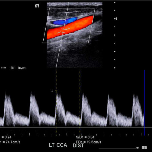 ULTRASONIDO DOPPLER ARTERIAL Y VENOSO 2 MIEMBROS: se utiliza para evaluar el flujo sanguíneo en las arterias y venas de las extremidades superiores e infe