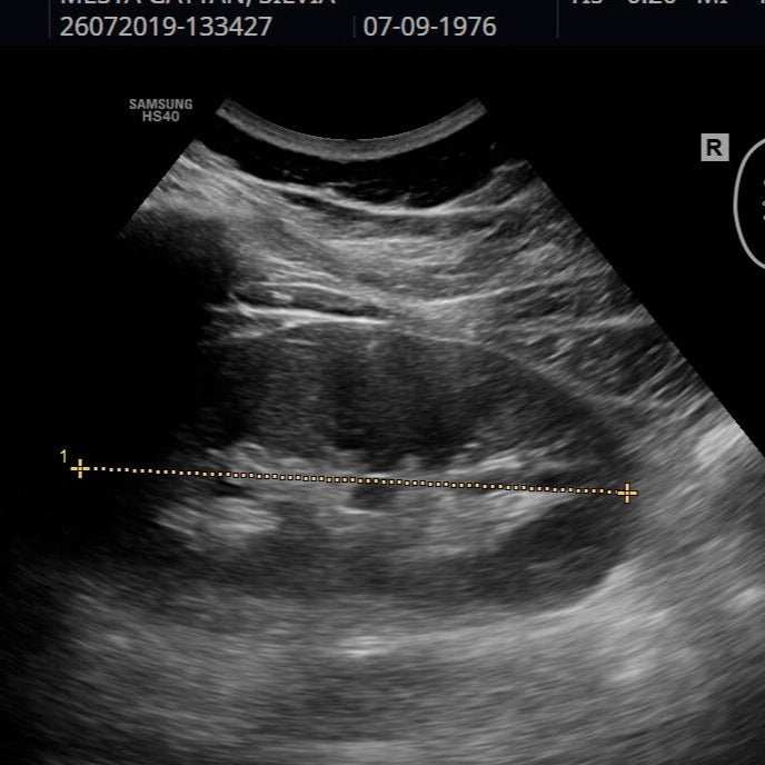 El ultrasonido renal es una herramienta de diagnóstico versátil y ampliamente utilizada en el campo de la medicina para evaluar la salud y función de los riñones y l